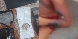 PE: Menino de 6 anos tem corpo queimado após celular explodir 