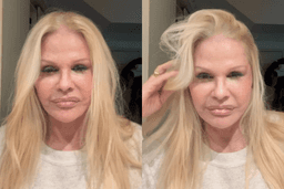 Monique Evans exibe resultado de minilifting