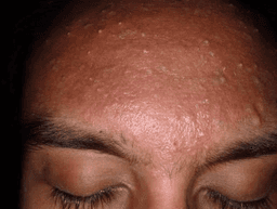 Pesquisa: 45% dos jovens usam TikTok como fonte para dúvidas sobre acne