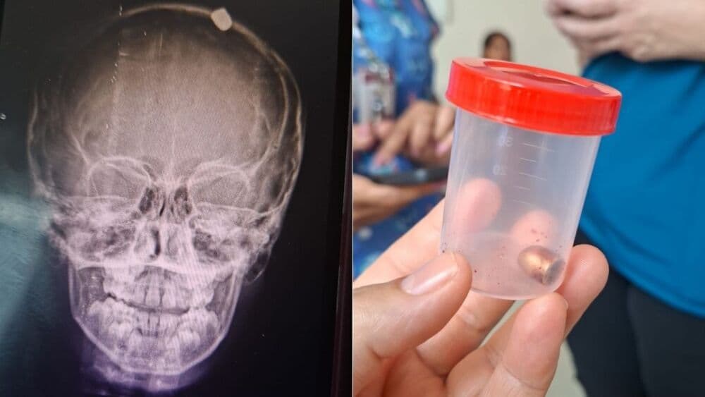Raio-x mostra bala alojada no crânio de menino atingido durante virada do ano em Contagem