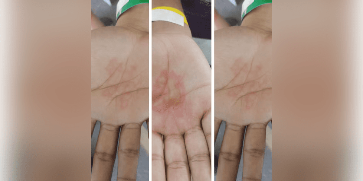 Mãos dos três adolescentes com queimaduras por causa de tortura provocada pelo pai. — Foto: Redes sociais