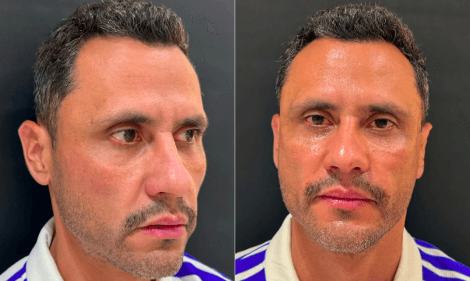Cleitinho faz harmonização facial após eleição